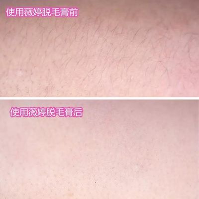 我用薇婷脱毛膏去除它